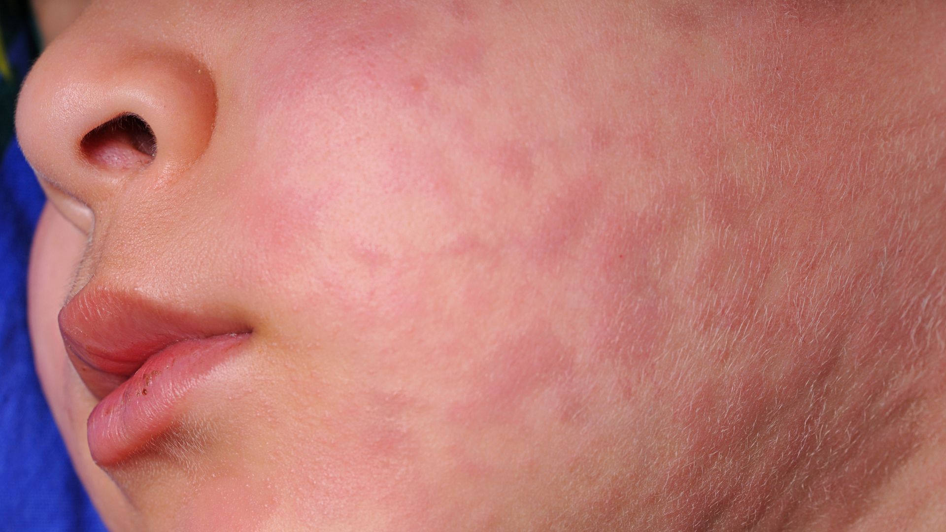 Waspada KLB Campak di Indonesia: Kasus Meningkat, Imunisasi Menjadi Kunci